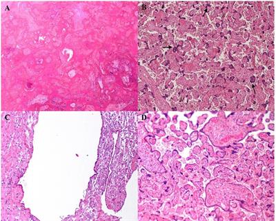 Placental lesions in patients with antiphospholipid antibody syndrome: experience of a single tertiary-care Italian reference center